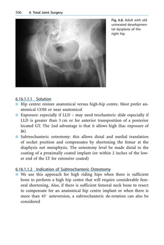 6.16.1.1.1 Solution
n Hip centre: restore anatomical versus high-hip centre. Most prefer an-
atomical COM or near anatomical
n Exposure: especially if LLD ± may need trochanteric slide especially if
LLD is greater than 3 cm or for anterior transposition of a posterior
located GT. The 2nd advantage is that it allows high iliac exposure of
BG
n Subtrochanteric osteotomy: this allows distal and medial translation
of socket position and compensates by shortening the femur at the
diaphysis not metaphysis. The osteotomy level be made distal to the
coating of a proximally coated implant (or within 2 inches of the low-
er end of the LT for extensive coated)
6.16.1.1.2 Indication of Subtrochanteric Osteotomy
n We use this approach for high riding hips when there is sufficient
bone to perform a high hip centre that will require considerable fem-
oral shortening. Also, if there is sufficient femoral neck bone to resect
to compensate for an anatomical hip centre implant or when there is
more than 458 anteversion, a subtrochanteric de-rotation can also be
considered
506 6 Total Joint Surgery
Fig. 6.8. Adult with old
untreated developmen-
tal dysplasia of the
right hip
 
