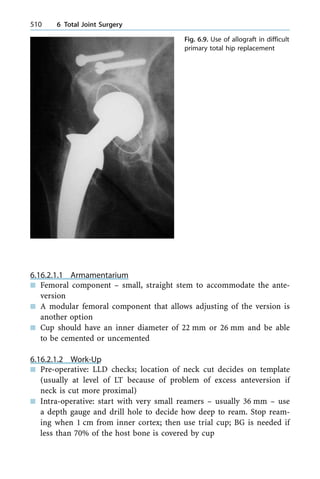 6.16.2.1.1 Armamentarium
n Femoral component ± small, straight stem to accommodate the ante-
version
n A modular femoral component that allows adjusting of the version is
another option
n Cup should have an inner diameter of 22 mm or 26 mm and be able
to be cemented or uncemented
6.16.2.1.2 Work-Up
n Pre-operative: LLD checks; location of neck cut decides on template
(usually at level of LT because of problem of excess anteversion if
neck is cut more proximal)
n Intra-operative: start with very small reamers ± usually 36 mm ± use
a depth gauge and drill hole to decide how deep to ream. Stop ream-
ing when 1 cm from inner cortex; then use trial cup; BG is needed if
less than 70% of the host bone is covered by cup
510 6 Total Joint Surgery
Fig. 6.9. Use of allograft in difficult
primary total hip replacement
 