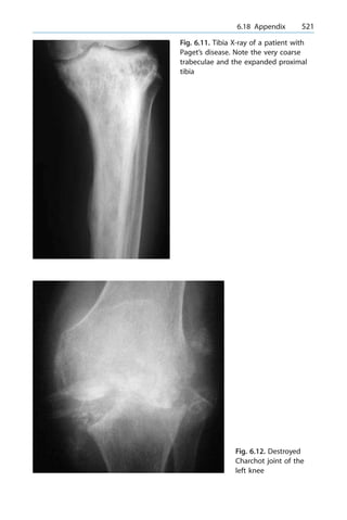a 6.18 Appendix 521
Fig. 6.11. Tibia X-ray of a patient with
Paget's disease. Note the very coarse
trabeculae and the expanded proximal
tibia
Fig. 6.12. Destroyed
Charchot joint of the
left knee
 