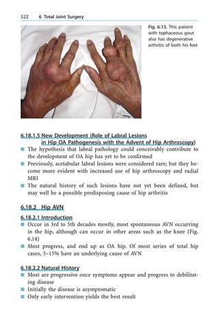 6.18.1.5 New Development (Role of Labral Lesions
in Hip OA Pathogenesis with the Advent of Hip Arthroscopy)
n The hypothesis that labral pathology could conceivably contribute to
the development of OA hip has yet to be confirmed
n Previously, acetabular labral lesions were considered rare; but they be-
come more evident with increased use of hip arthroscopy and radial
MRI
n The natural history of such lesions have not yet been defined, but
may well be a possible predisposing cause of hip arthritis
6.18.2 Hip AVN
6.18.2.1 Introduction
n Occur in 3rd to 5th decades mostly, most spontaneous AVN occurring
in the hip, although can occur in other areas such as the knee (Fig.
6.14)
n Most progress, and end up as OA hip. Of most series of total hip
cases, 5±15% have an underlying cause of AVN
6.18.2.2 Natural History
n Most are progressive once symptoms appear and progress to debilitat-
ing disease
n Initially the disease is asymptomatic
n Only early intervention yields the best result
522 6 Total Joint Surgery
Fig. 6.13. This patient
with tophaceous gout
also has degenerative
arthritis of both his feet
 