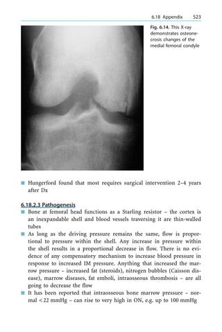 n Hungerford found that most requires surgical intervention 2±4 years
after Dx
6.18.2.3 Pathogenesis
n Bone at femoral head functions as a Starling resistor ± the cortex is
an inexpandable shell and blood vessels traversing it are thin-walled
tubes
n As long as the driving pressure remains the same, flow is propor-
tional to pressure within the shell. Any increase in pressure within
the shell results in a proportional decrease in flow. There is no evi-
dence of any compensatory mechanism to increase blood pressure in
response to increased IM pressure. Anything that increased the mar-
row pressure ± increased fat (steroids), nitrogen bubbles (Caisson dis-
ease), marrow diseases, fat emboli, intraosseous thrombosis ± are all
going to decrease the flow
n It has been reported that intraosseous bone marrow pressure ± nor-
mal <22 mmHg ± can rise to very high in ON, e.g. up to 100 mmHg
a 6.18 Appendix 523
Fig. 6.14. This X-ray
demonstrates osteone-
crosis changes of the
medial femoral condyle
 
