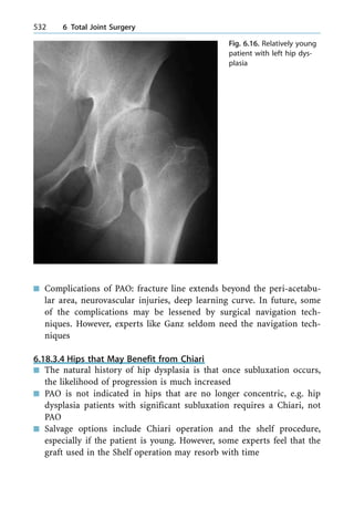 n Complications of PAO: fracture line extends beyond the peri-acetabu-
lar area, neurovascular injuries, deep learning curve. In future, some
of the complications may be lessened by surgical navigation tech-
niques. However, experts like Ganz seldom need the navigation tech-
niques
6.18.3.4 Hips that May Benefit from Chiari
n The natural history of hip dysplasia is that once subluxation occurs,
the likelihood of progression is much increased
n PAO is not indicated in hips that are no longer concentric, e.g. hip
dysplasia patients with significant subluxation requires a Chiari, not
PAO
n Salvage options include Chiari operation and the shelf procedure,
especially if the patient is young. However, some experts feel that the
graft used in the Shelf operation may resorb with time
532 6 Total Joint Surgery
Fig. 6.16. Relatively young
patient with left hip dys-
plasia
 