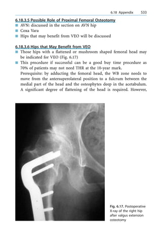 6.18.3.5 Possible Role of Proximal Femoral Osteotomy
n AVN: discussed in the section on AVN hip
n Coxa Vara
n Hips that may benefit from VEO will be discussed
6.18.3.6 Hips that May Benefit from VEO
n Those hips with a flattened or mushroom shaped femoral head may
be indicated for VEO (Fig. 6.17)
n This procedure if successful can be a good buy time procedure as
70% of patients may not need THR at the 10-year mark.
Prerequisite: by adducting the femoral head, the WB zone needs to
move from the antersuperolateral position to a fulcrum between the
medial part of the head and the osteophytes deep in the acetabulum.
A significant degree of flattening of the head is required. However,
a 6.18 Appendix 533
Fig. 6.17. Postoperative
X-ray of the right hip
after valgus extension
osteotomy
 