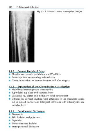 7.2.3 General Portals of Entry
n Blood-borne: mostly in children and IV addicts
n Extension from surrounding infected area
n Direct inoculation: as in open fracture and after surgery
7.2.4 Explanation of the Cierny-Mader Classification
n Medullary: haematogenous osteomyelitis
n Superficial: e.g. ulcer with exposed bone
n Localised: e.g. cortex and medullary canal involvement
n Diffuse: e.g. cortical involved with extension to the medullary canal.
`All un-united fracture and total joint infections with osteomyelitis are
included here'
7.2.5 Debridement Technique
n Atraumatic
n Skin incision and prior scar
n Expansile
n `Pants-over-vest' incision
n Extra-periosteal dissection
546 7 Orthopaedic Infections
Fig. 7.1. A tibia with chronic osteomyelitis changes
 