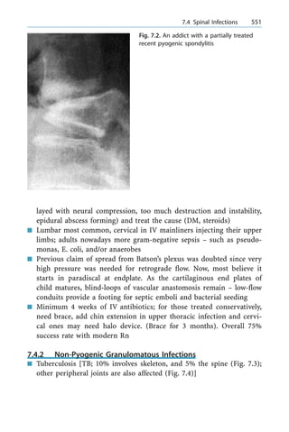 layed with neural compression, too much destruction and instability,
epidural abscess forming) and treat the cause (DM, steroids)
n Lumbar most common, cervical in IV mainliners injecting their upper
limbs; adults nowadays more gram-negative sepsis ± such as pseudo-
monas, E. coli, and/or anaerobes
n Previous claim of spread from Batson's plexus was doubted since very
high pressure was needed for retrograde flow. Now, most believe it
starts in paradiscal at endplate. As the cartilaginous end plates of
child matures, blind-loops of vascular anastomosis remain ± low-flow
conduits provide a footing for septic emboli and bacterial seeding
n Minimum 4 weeks of IV antibiotics; for those treated conservatively,
need brace, add chin extension in upper thoracic infection and cervi-
cal ones may need halo device. (Brace for 3 months). Overall 75%
success rate with modern Rn
7.4.2 Non-Pyogenic Granulomatous Infections
n Tuberculosis [TB; 10% involves skeleton, and 5% the spine (Fig. 7.3);
other peripheral joints are also affected (Fig. 7.4)]
a 7.4 Spinal Infections 551
Fig. 7.2. An addict with a partially treated
recent pyogenic spondylitis
 