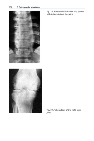 552 7 Orthopaedic Infections
Fig. 7.3. Paravertebral shadow in a patient
with tuberculosis of the spine
Fig. 7.4. Tuberculosis of the right knee
joint
 