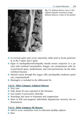 n In cervical spine most occur anteriorly; while tend to locate posterior-
ly in the T-spine and L-spine
n Signs of myelopathy/radiculopathy should arouse suspicion in a pa-
tient with vertebral osteomyelitis. Danger: can communicate with ret-
ro-peritoneal space, mediastinum, and retro-peritoneum via the inter-
vertebral foramen
n Natural course through five stages: LBP, raiculopathy, weakness, paral-
ysis, toxaemia/death
n Meningitis is included in the differential Dx
7.4.3.2 Other Category: Subdural Abscess
n Very rare
n Only about 50 cases reported in the literature
n Less tender to percussion clinically
n Neurology due more to ischaemia and compression
n More in DM and pregnant individuals (liquefaction necrosis, less in-
flammation)
7.4.3.3 Other Category: IM Abscess
n Said to occur sometimes even in otherwise healthy subjects
n Rare
a 7.4 Spinal Infections 555
Fig. 7.5. Epidural abscess seen in this
sagittal magnetic resonance image.
Epidural abscess is toxic to the patient
 