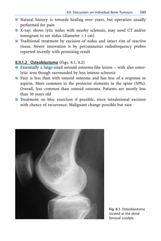 n Natural history is towards healing over years, but operation usually
performed for pain
n X-ray: shows lytic nidus with nearby sclerosis, may need CT and/or
tomogram to see nidus (diameter <1 cm)
n Traditional treatment by excision of nidus and intact rim of reactive
tissue. Newer innovation is by percutaneous radiofrequency probes
reported recently with promising result
8.9.1.2 Osteoblastoma (Figs. 8.1, 8.2)
n Essentially a large-sized osteoid osteoma-like lesion ± with also osteo-
lytic area though surrounded by less intense sclerosis
n Pain is less than with osteoid osteoma and has less of a response to
aspirin. More common in the posterior elements in the spine (50%).
Overall, less common than osteoid osteoma. Patients are mostly less
than 30 years old
n Treatment: en bloc resection if possible, since intralesional excision
with chance of recurrence. Malignant change possible but rare
a 8.9 Discussion on Individual Bone Tumours 589
Fig. 8.1. Osteoblastoma
located at the distal
femoral condyle
 