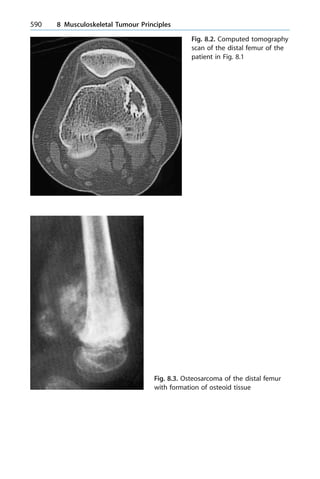 590 8 Musculoskeletal Tumour Principles
Fig. 8.2. Computed tomography
scan of the distal femur of the
patient in Fig. 8.1
Fig. 8.3. Osteosarcoma of the distal femur
with formation of osteoid tissue
 