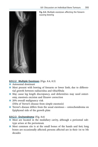 8.9.2.2 Multiple Exostoses (Figs. 8.4, 8.5)
n Autosomal dominant
n Most present with bowing of forearm or lower limb, due to differen-
tial growth between radius/ulna and tibia/fibula
n May cause leg length discrepancy, and deformities may need osteot-
omy, exostosis excision and Ilizarov correction
n 20% overall malignancy risk
(DDx of Trevor's disease from simple exostosis)
n Trevor's disease differs from the usual exostoses ± osteochondroma on
Epiphyseal side of the growth plate
8.9.2.3 Enchondroma (Fig. 8.6)
n Most are located in the medullary cavity, although a periosteal sub-
type arises at the periosteum
n Most common site is at the small bones of the hands and feet; long
bones are occasionally affected; persons affected are in their 1st to 5th
decades
a 8.9 Discussion on Individual Bone Tumours 593
Fig. 8.4. Multiple exostoses affecting the forearm
causing bowing
 
