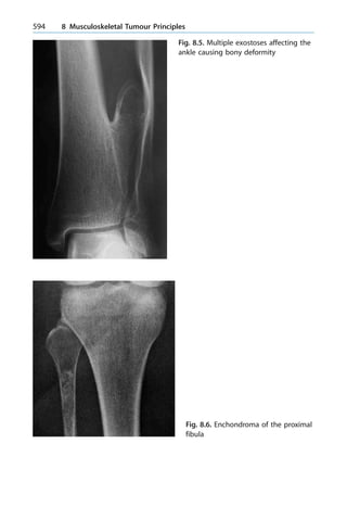 594 8 Musculoskeletal Tumour Principles
Fig. 8.5. Multiple exostoses affecting the
ankle causing bony deformity
Fig. 8.6. Enchondroma of the proximal
fibula
 