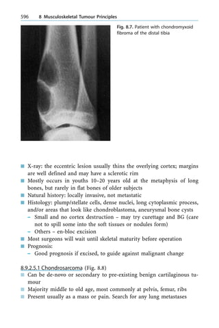 n X-ray: the eccentric lesion usually thins the overlying cortex; margins
are well defined and may have a sclerotic rim
n Mostly occurs in youths 10±20 years old at the metaphysis of long
bones, but rarely in flat bones of older subjects
n Natural history: locally invasive, not metastatic
n Histology: plump/stellate cells, dense nuclei, long cytoplasmic process,
and/or areas that look like chondroblastoma, aneurysmal bone cysts
± Small and no cortex destruction ± may try curettage and BG (care
not to spill some into the soft tissues or nodules form)
± Others ± en-bloc excision
n Most surgeons will wait until skeletal maturity before operation
n Prognosis:
± Good prognosis if excised, to guide against malignant change
8.9.2.5.1 Chondrosarcoma (Fig. 8.8)
n Can be de-novo or secondary to pre-existing benign cartilaginous tu-
mour
n Majority middle to old age, most commonly at pelvis, femur, ribs
n Present usually as a mass or pain. Search for any lung metastases
596 8 Musculoskeletal Tumour Principles
Fig. 8.7. Patient with chondromyxoid
fibroma of the distal tibia
 