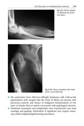 n The polyostotic form (McCune-Albright Syndrome with Caf-au-lait
pigmentation with margins like the Coast of Maine can present with
precocious puberty and chance of malignant transformation of 4%;
more in females than in males) can present with pathological fracture
n Treatment: monostotic and symptomatic sites of polyostotic may need
curettage and grafting. Deformities if significant may require osteot-
omy and/or lengthening/shortening procedures
a 8.9 Discussion on Individual Bone Tumours 599
Fig. 8.9. Fibrous dyspla-
sia affecting the proxi-
mal radius
Fig. 8.10. Fibrous dysplasia with shep-
herd's crook deformity
 
