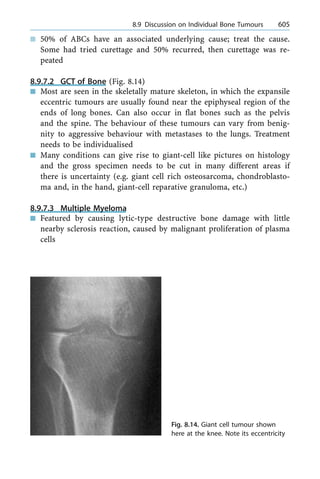 n 50% of ABCs have an associated underlying cause; treat the cause.
Some had tried curettage and 50% recurred, then curettage was re-
peated
8.9.7.2 GCT of Bone (Fig. 8.14)
n Most are seen in the skeletally mature skeleton, in which the expansile
eccentric tumours are usually found near the epiphyseal region of the
ends of long bones. Can also occur in flat bones such as the pelvis
and the spine. The behaviour of these tumours can vary from benig-
nity to aggressive behaviour with metastases to the lungs. Treatment
needs to be individualised
n Many conditions can give rise to giant-cell like pictures on histology
and the gross specimen needs to be cut in many different areas if
there is uncertainty (e.g. giant cell rich osteosarcoma, chondroblasto-
ma and, in the hand, giant-cell reparative granuloma, etc.)
8.9.7.3 Multiple Myeloma
n Featured by causing lytic-type destructive bone damage with little
nearby sclerosis reaction, caused by malignant proliferation of plasma
cells
a 8.9 Discussion on Individual Bone Tumours 605
Fig. 8.14. Giant cell tumour shown
here at the knee. Note its eccentricity
 