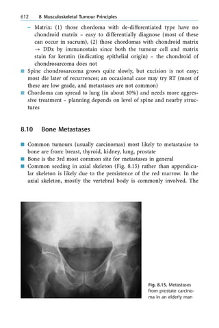 ± Matrix: (1) those chordoma with de-differentiated type have no
chondroid matrix ± easy to differentially diagnose (most of these
can occur in sacrum), (2) those chordomas with chondroid matrix
? DDx by immunostain since both the tumour cell and matrix
stain for keratin (indicating epithelial origin) ± the chondroid of
chondrosarcoma does not
n Spine chondrosarcoma grows quite slowly, but excision is not easy;
most die later of recurrences; an occasional case may try RT (most of
these are low grade, and metastases are not common)
n Chordoma can spread to lung (in about 30%) and needs more aggres-
sive treatment ± planning depends on level of spine and nearby struc-
tures
8.10 Bone Metastases
n Common tumours (usually carcinomas) most likely to metastasise to
bone are from: breast, thyroid, kidney, lung, prostate
n Bone is the 3rd most common site for metastases in general
n Common seeding in axial skeleton (Fig. 8.15) rather than appendicu-
lar skeleton is likely due to the persistence of the red marrow. In the
axial skeleton, mostly the vertebral body is commonly involved. The
612 8 Musculoskeletal Tumour Principles
Fig. 8.15. Metastases
from prostate carcino-
ma in an elderly man
 