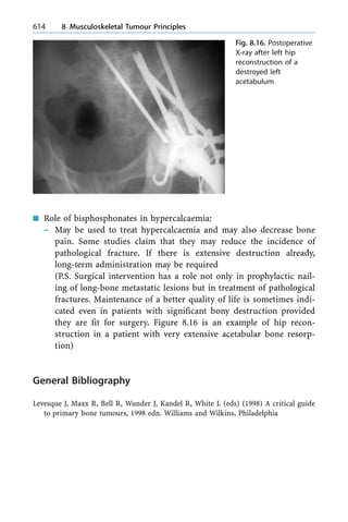 n Role of bisphosphonates in hypercalcaemia:
± May be used to treat hypercalcaemia and may also decrease bone
pain. Some studies claim that they may reduce the incidence of
pathological fracture. If there is extensive destruction already,
long-term administration may be required
(P.S. Surgical intervention has a role not only in prophylactic nail-
ing of long-bone metastatic lesions but in treatment of pathological
fractures. Maintenance of a better quality of life is sometimes indi-
cated even in patients with significant bony destruction provided
they are fit for surgery. Figure 8.16 is an example of hip recon-
struction in a patient with very extensive acetabular bone resorp-
tion)
General Bibliography
Levesque J, Maxx R, Bell R, Wunder J, Kandel R, White L (eds) (1998) A critical guide
to primary bone tumours, 1998 edn. Williams and Wilkins, Philadelphia
614 8 Musculoskeletal Tumour Principles
Fig. 8.16. Postoperative
X-ray after left hip
reconstruction of a
destroyed left
acetabulum
 
