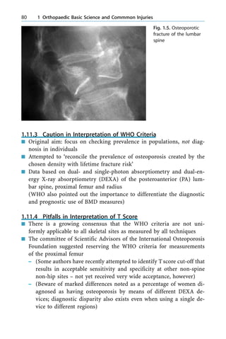 1.11.3 Caution in Interpretation of WHO Criteria
n Original aim: focus on checking prevalence in populations, not diag-
nosis in individuals
n Attempted to `reconcile the prevalence of osteoporosis created by the
chosen density with lifetime fracture risk'
n Data based on dual- and single-photon absorptiometry and dual-en-
ergy X-ray absorptiometry (DEXA) of the posteroanterior (PA) lum-
bar spine, proximal femur and radius
(WHO also pointed out the importance to differentiate the diagnostic
and prognostic use of BMD measures)
1.11.4 Pitfalls in Interpretation of T Score
n There is a growing consensus that the WHO criteria are not uni-
formly applicable to all skeletal sites as measured by all techniques
n The committee of Scientific Advisors of the International Osteoporosis
Foundation suggested reserving the WHO criteria for measurements
of the proximal femur
± (Some authors have recently attempted to identify Tscore cut-off that
results in acceptable sensitivity and specificity at other non-spine
non-hip sites ± not yet received very wide acceptance, however)
± (Beware of marked differences noted as a percentage of women di-
agnosed as having osteoporosis by means of different DEXA de-
vices; diagnostic disparity also exists even when using a single de-
vice to different regions)
80 1 Orthopaedic Basic Science and Commmon Injuries
Fig. 1.5. Osteoporotic
fracture of the lumbar
spine
 