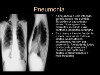 Pneumonia  A pneumonia é uma infecção ou inflamação nos pulmões. Ela pode ser causada por vários microorganismos diferentes, incluindo vírus, bactérias, parasitas ou fungos.  Esta doença é muito freqüente e afeta pessoas de todas as idades. Muitas destas, anualmente, morrem por pneumonia. A metade de todos os casos de pneumonia é causada por bactérias e, destas, o pneumococo é o mais freqüente 