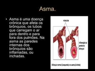 Asma. Asma é uma doença crônica que afeta os brônquios, os tubos que carregam o ar para dentro e para fora dos pulmões. Na asma as paredes internas dos brônquios são inflamadas, ou inchadas. 