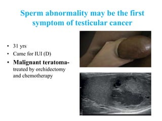 Sperm abnormality may be the first
symptom of testicular cancer
• 31 yrs
• Came for IUI (D)
• Malignant teratoma-
treated by orchidectomy
and chemotherapy
 