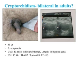 Cryptorchidism- bilateral in adults?
• 31 yr
• Azoospermia
• USG- Rt testis in lower abdomen, Lt testis in inguinal canal
• FSH 13.40. LH 6.87. Testo 6.89. E2 <10.
 
