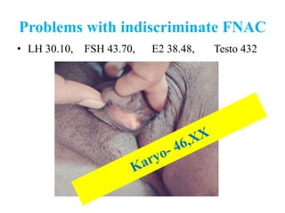 Problems with indiscriminate FNAC
• LH 30.10, FSH 43.70, E2 38.48, Testo 432
 