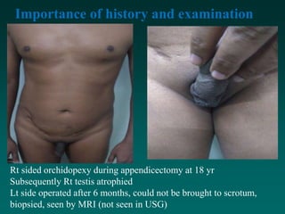 Importance of history and examination
Rt sided orchidopexy during appendicectomy at 18 yr
Subsequently Rt testis atrophied
Lt side operated after 6 months, could not be brought to scrotum,
biopsied, seen by MRI (not seen in USG)
 