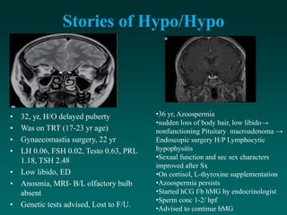 Stories of Hypo/Hypo
• 32, yr, H/O delayed puberty
• Was on TRT (17-23 yr age)
• Gynaecomastia surgery, 22 yr
• LH 0.06, FSH 0.02, Testo 0.63, PRL
1.18, TSH 2.48
• Low libido, ED
• Anosmia, MRI- B/L olfactory bulb
absent
• Genetic tests advised, Lost to F/U.
•36 yr, Azoospermia
•sudden loss of body hair, low libido→
nonfunctioning Pituitary macroadenoma →
Endoscopic surgery H/P Lymphocytic
hypophysitis
•Sexual function and sec sex characters
improved after Sx
•On cortisol, L-thyroxine supplementation
•Azoospermia persists
•Started hCG f/b hMG by endocrinologist
•Sperm conc 1-2/ hpf
•Advised to continue hMG
 