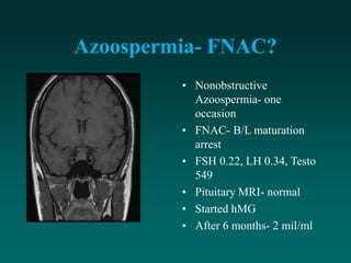 Azoospermia- FNAC?
• Nonobstructive
Azoospermia- one
occasion
• FNAC- B/L maturation
arrest
• FSH 0.22, LH 0.34, Testo
549
• Pituitary MRI- normal
• Started hMG
• After 6 months- 2 mil/ml
 
