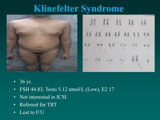 Klinefelter Syndrome
• 36 yr.
• FSH 44.83, Testo 5.12 nmol/L (Low), E2 17
• Not interested in ICSI
• Referred for TRT
• Lost to F/U
 