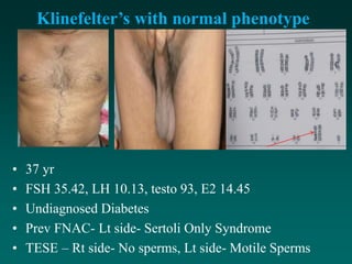 Klinefelter’s with normal phenotype
• 37 yr
• FSH 35.42, LH 10.13, testo 93, E2 14.45
• Undiagnosed Diabetes
• Prev FNAC- Lt side- Sertoli Only Syndrome
• TESE – Rt side- No sperms, Lt side- Motile Sperms
 