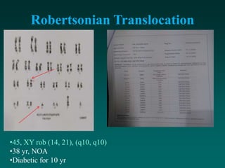 Robertsonian Translocation
•45, XY rob (14, 21), (q10, q10)
•38 yr, NOA
•Diabetic for 10 yr
 