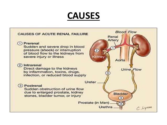 Acute Renal Failure Overview