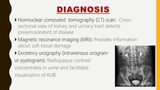 DIAGNOSIS
 Nonnuclear computed tomography (CT) scan: Cross-
sectional view of kidney and urinary tract detects
presence/extent of disease
 Magnetic resonance imaging (MRI): Provides information
about soft tissue damage
 Excretory urography (intravenous urogram
or pyelogram): Radiopaque contrast
concentrates in urine and facilitates
visualization of KUB.
 