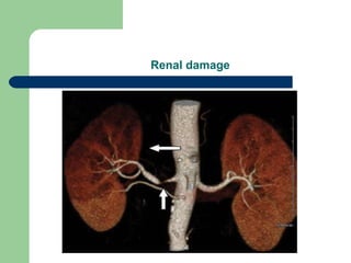 Renal damage
 