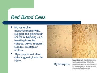 Red Blood Cells
 Monomorphic
(nondysmorphic)RBC
suggest non-glomerular
source of bleeding – i.e.,
bleeding from the
calyces, pelvis, ureter(s),
bladder, prostate or
urethra.
 Dysmorphic red blood
cells suggest glomerular
injury.
Dysmorphic
 