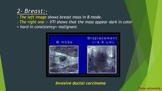 - The left image shows breast mass in B mode.
- The right one :- VTI shows that the mass appear dark in color
= hard in consistency= malignant.
Invasive ductal carcinoma
Duke university
 