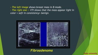 - The left image shows breast mass in B mode.
- The right one :- VTI shows that the mass appear light in
color = soft in consistency= benign.
Fibroadenoma
Duke university
 