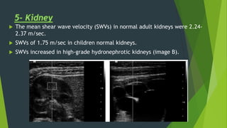  The mean shear wave velocity (SWVs) in normal adult kidneys were 2.24-
2.37 m/sec.
 SWVs of 1.75 m/sec in children normal kidneys.
 SWVs increased in high-grade hydronephrotic kidneys (image B).
 