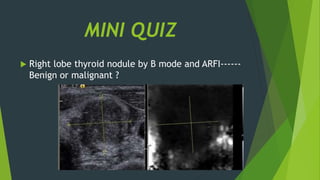 MINI QUIZ
 Right lobe thyroid nodule by B mode and ARFI------
Benign or malignant ?
 