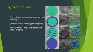Thyroid nodules
Four different patterns have been described
including :-
"patterns 3 and 4" that suggest malignancy
While "patterns 1 and 2" indicate thyroid
nodule benignity.
 