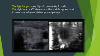 The left image shows thyroid nodule by B mode.
The right one :- VTI shows that the nodule appear dark
in color = hard in consistency= malignancy.
 