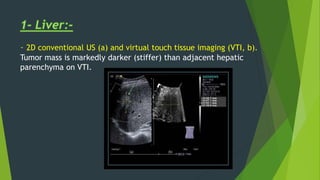 - 2D conventional US (a) and virtual touch tissue imaging (VTI, b).
Tumor mass is markedly darker (stiffer) than adjacent hepatic
parenchyma on VTI.
 