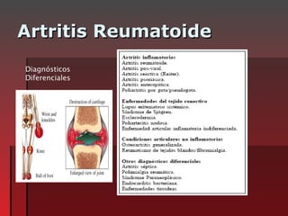 Artritis Reumatoide  Diagnósticos Diferenciales 