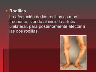 <ul><li>Rodillas .  </li></ul><ul><li>La afectación de las rodillas es muy frecuente, siendo al inicio la artritis unilate...