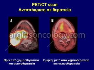 PET/CT scan
Ανταπόκριση σε θεραπεία
Πριν από χημειοθεραπεία
και ακτινοθεραπεία
2 μήνες μετά από χημειοθεραπεία
και ακτινοθεραπεία
 