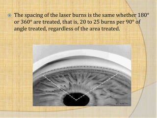  The spacing of the laser burns is the same whether 180°
or 360° are treated, that is, 20 to 25 burns per 90° of
angle treated, regardless of the area treated.
 