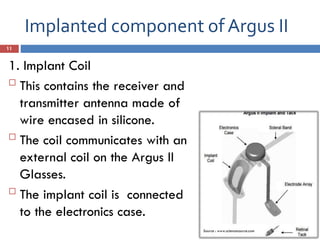 Implanted component of Argus II
11
1. Implant Coil

This contains the receiver and
transmitter antenna made of
wire encased in silicone.

The coil communicates with an
external coil on the Argus II
Glasses.

The implant coil is connected
to the electronics case.
Source : www.sciencesource.com
 