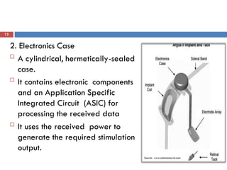 12
2. Electronics Case

A cylindrical, hermetically-sealed
case.

It contains electronic components
and an Application Specific
Integrated Circuit (ASIC) for
processing the received data

It uses the received power to
generate the required stimulation
output.
Source : www.sciencesource.com
 