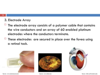 13
3. Electrode Array

The electrode array consists of a polymer cable that contains
the wire conductors and an array of 60 enabled platinum
electrodes where the conductors terminate.

These electrodes are secured in place over the fovea using
a retinal tack.
Source : helix.northwestern.eduSource : www.sciencesource.com Source : www.zdnet.com
 